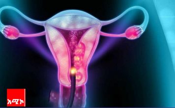 ከ64 ሺህ በላይ ለሚኾኑ ልጃገረዶች የማህጸን በር ካንሰር መከላከያ ክትባት እንደሚሰጥ የኦሮሞ ብሔረሰብ አሥተዳደር ጤና መምሪያ ገለጸ።