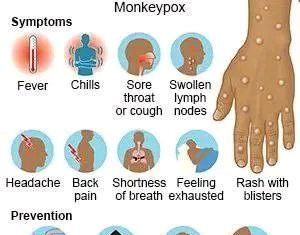 የዝንጀሮ ፈንጣጣ በሽታ መተላለፊያ እና መከላከያ መንገዶቹ!