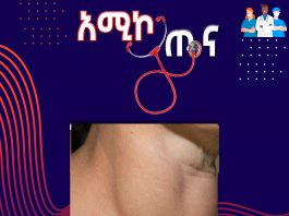 የእንቅርት በሽታ ምንድን ነው?