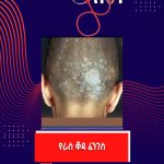 የራስ ቆዳ ፈንገስ ምንድን ነው? 569925714_1249006660590589_3219201391799903594_n