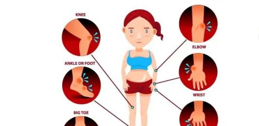 ስለሪህ በሽታ ምን እንወቅ?