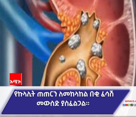 የኩላሊት ጠጠር ሕመምን እንዴት መከላከል ይቻላል ?