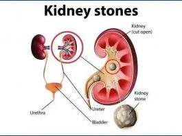 የኩላሊት ጠጠር በሽታ ምልክት፣ ሕክምና እና መከላከያው
