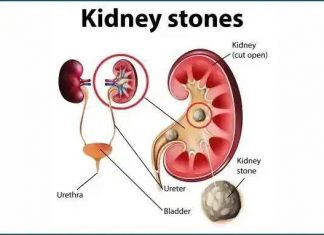 የኩላሊት ጠጠር በሽታ ምልክት፣ ሕክምና እና መከላከያው